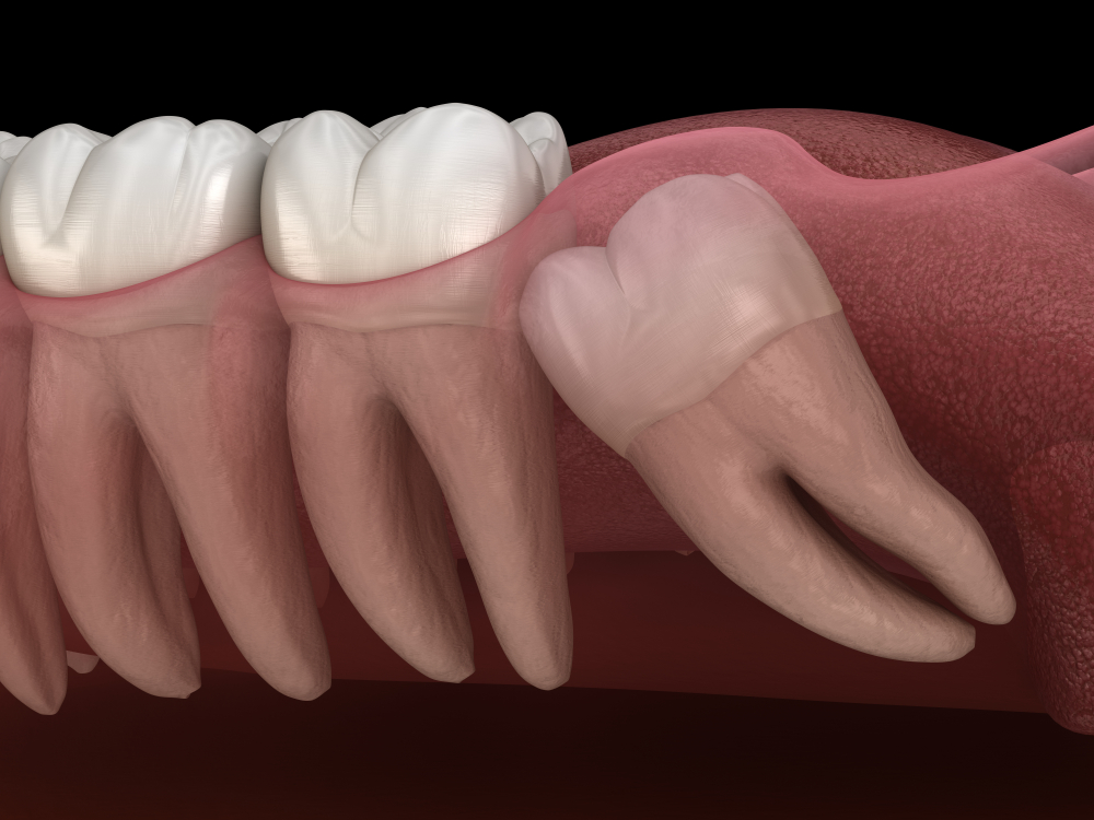 Merrylands Wisdom Tooth Dental Burwood