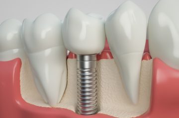 Dental Implants Burwood