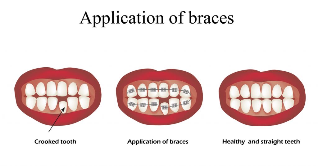 Strathfield Braces Clear Braces Strathfield Braces Parramatta
