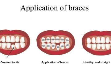 Strathfield Braces Clear Braces Strathfield Braces Parramatta