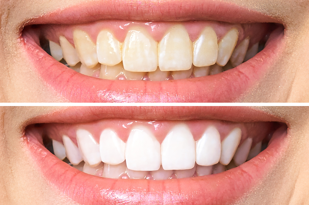 Teeth Whitening Strathfield