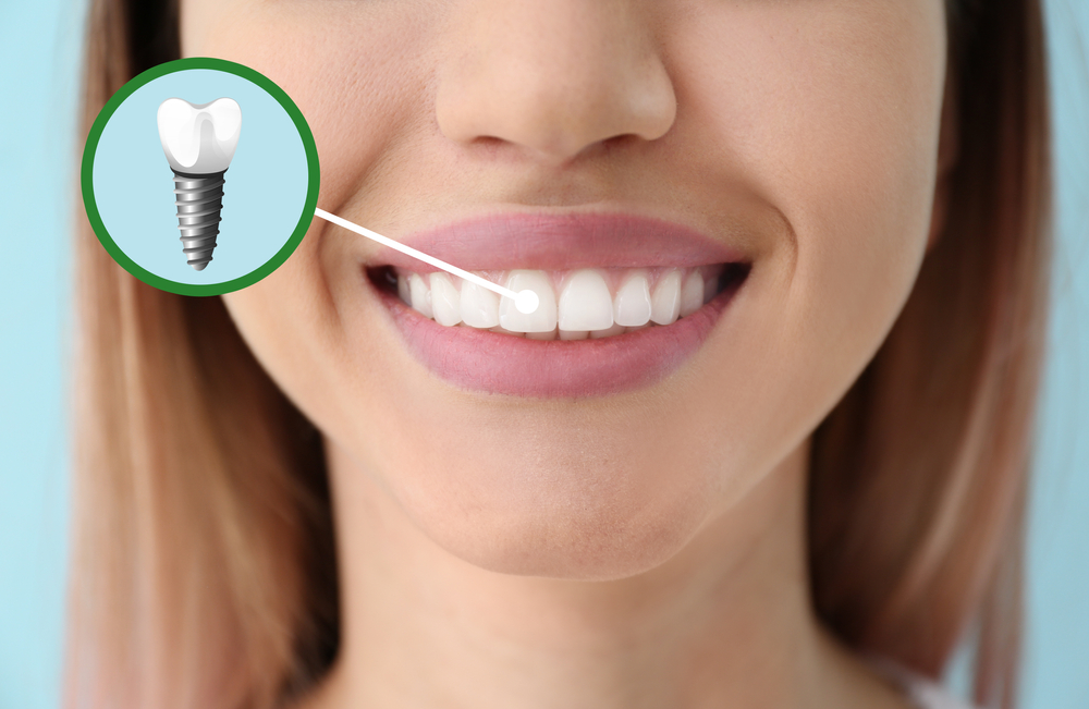 Dental Implant Strathfield