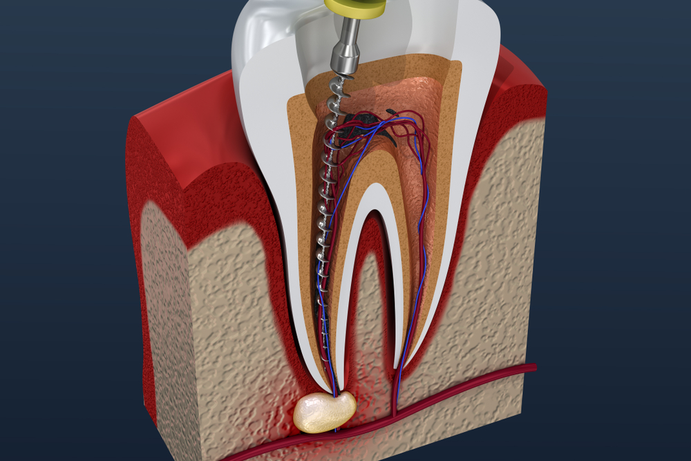 Dentist Greystanes Root Canal.