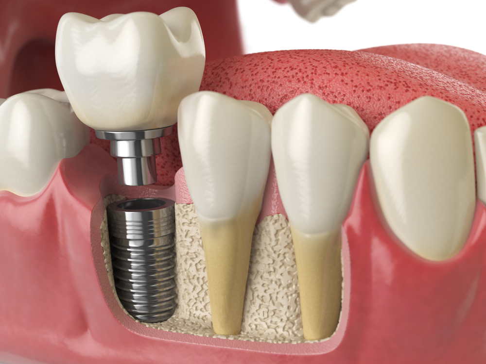 Dental Burwood