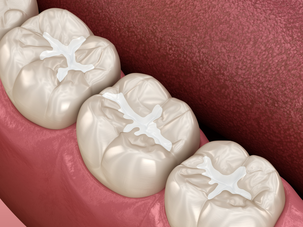 Westmead Dentist Sealants